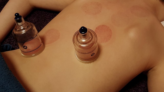 Cupping Therapy Glasgow